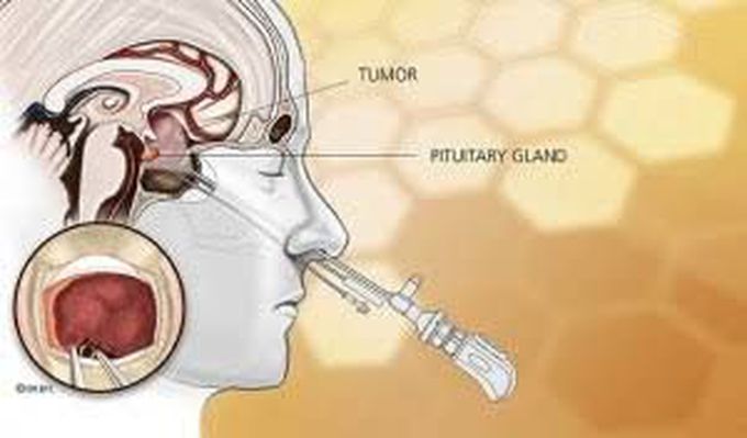 Pituitary gland adenoma treatment