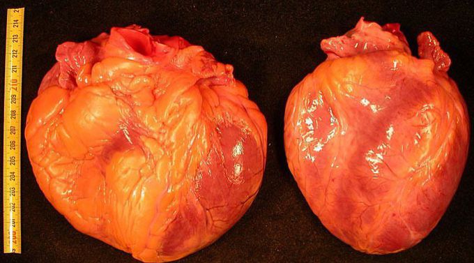Cardiomyopathy