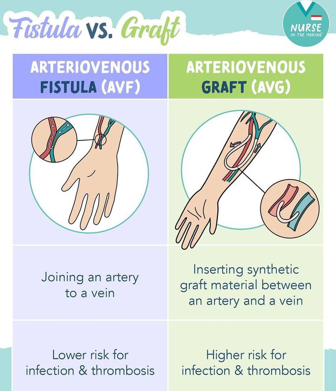 Fistula Vs. Graft