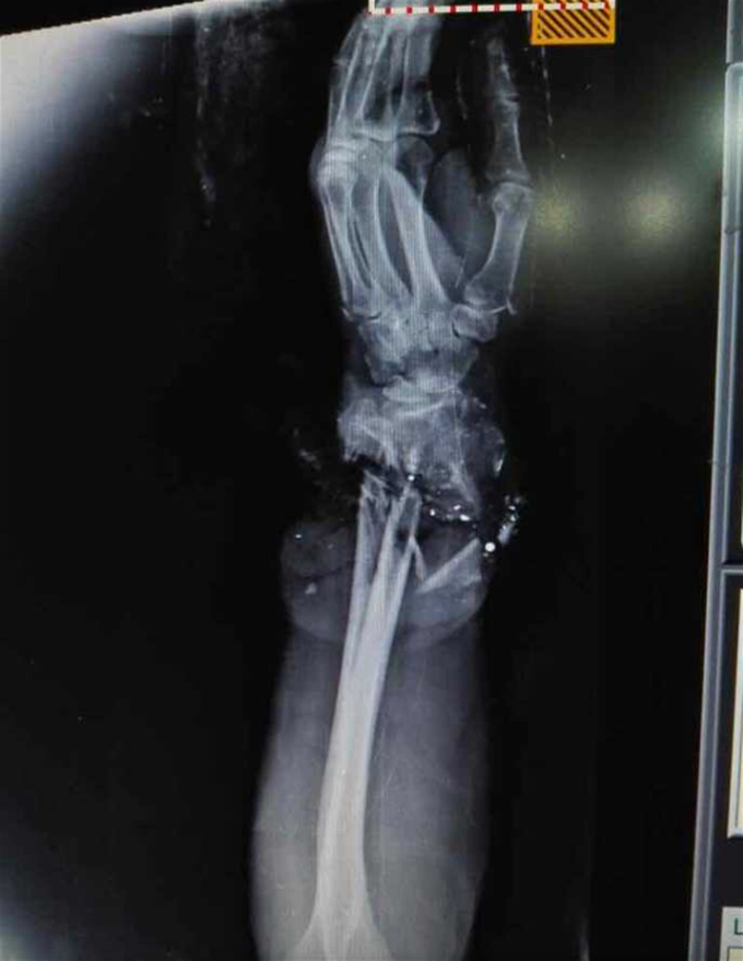 X-ray of a man who suffered a horrific crush injury to his - MEDizzy