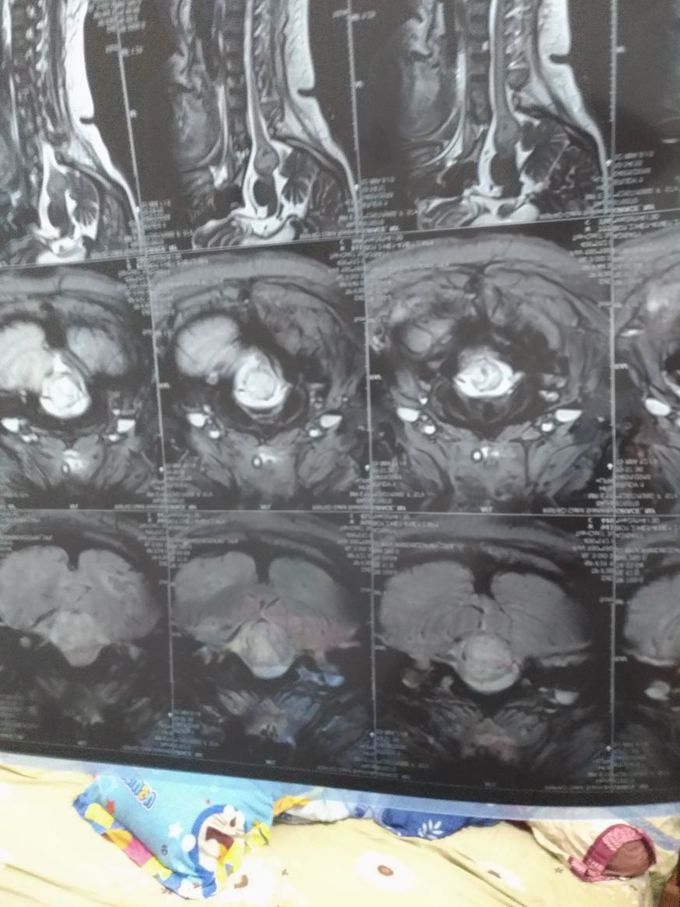 Brain cancer