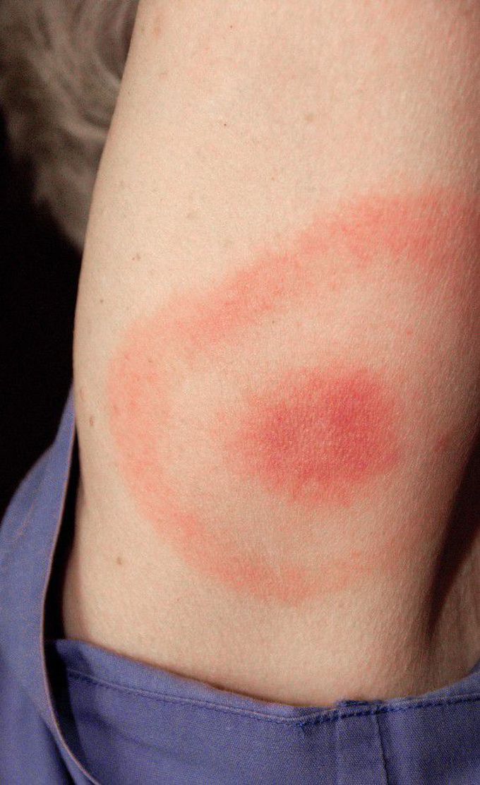 Lyme Disease