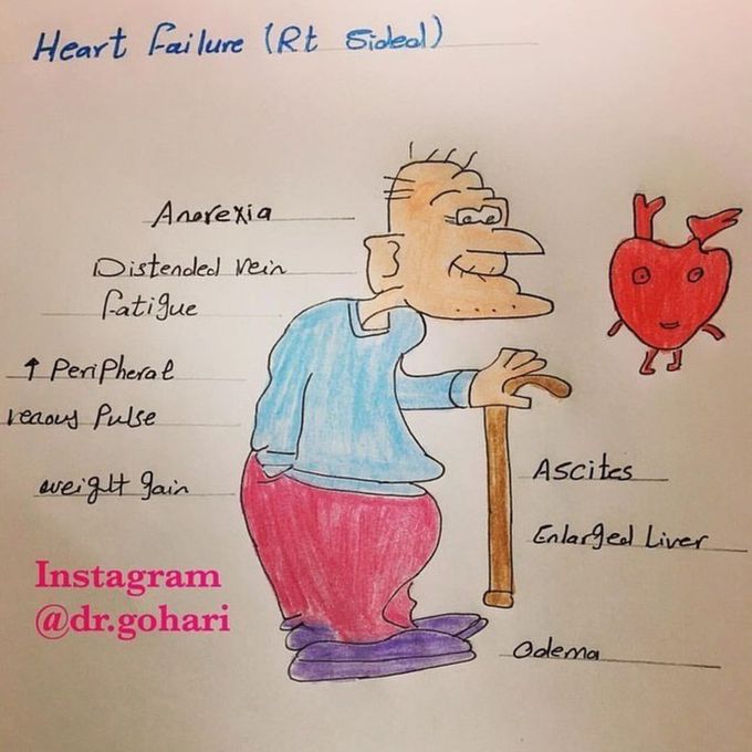 Right sided heart failure