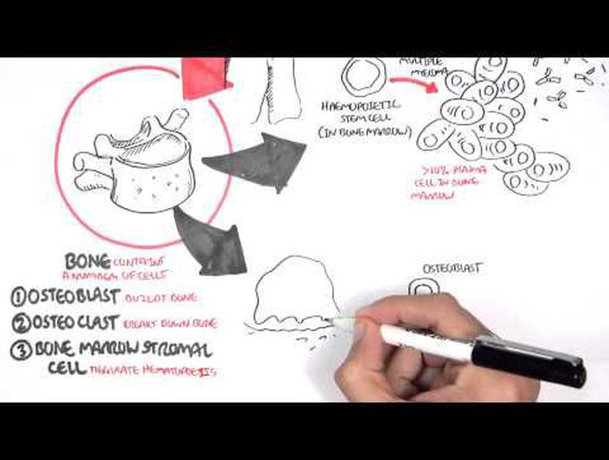 Medicine - Multiple Myeloma
