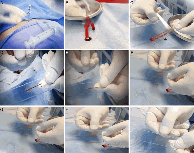 Preparing the bone marrow smear. (A) When the bone marrow aspiration needle is in place, use a 20 ml syringe to draw 1 ml of aspirate. (B) Place a few drops of aspirate on a slide held vertically to facilitate visualisation of the bone marrow spicules. (C) Using the edge of a second slide, separate and isolate a few bone marrow spicules from the rest of the sample. (D) Transfer these to a third slide. (E) Without applying pressure, distribute the spicules in the centre of the slide. (F) Place the second slide across the third slide to form a cross with the spicules in the centre. (G) Gently but quickly slide the second slide over the third slide to extend the spicules along its length. (H) Make sure the aspirate is spread evenly over the entire slide. (I) Allow to dry for 5 min, and then send it to the lab for tincture.  