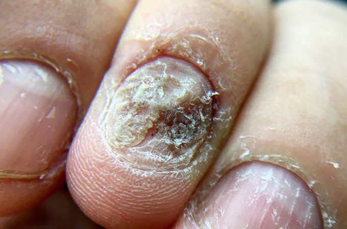 Psoriasis of the nail