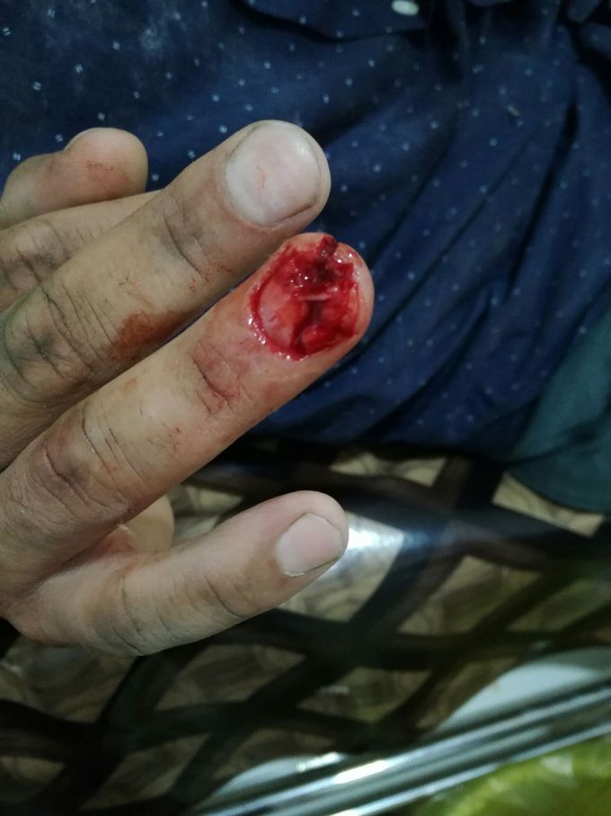 30 years old male injury caused by sharp material