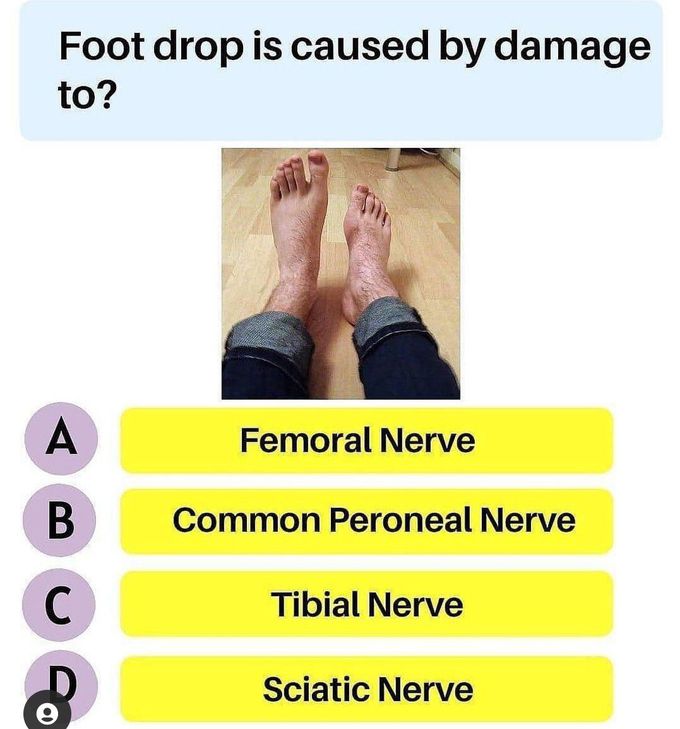 Foot drop caused by