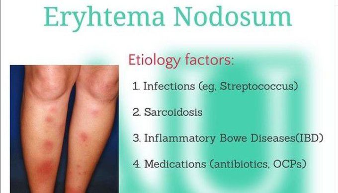 Cause of erythema nodosum