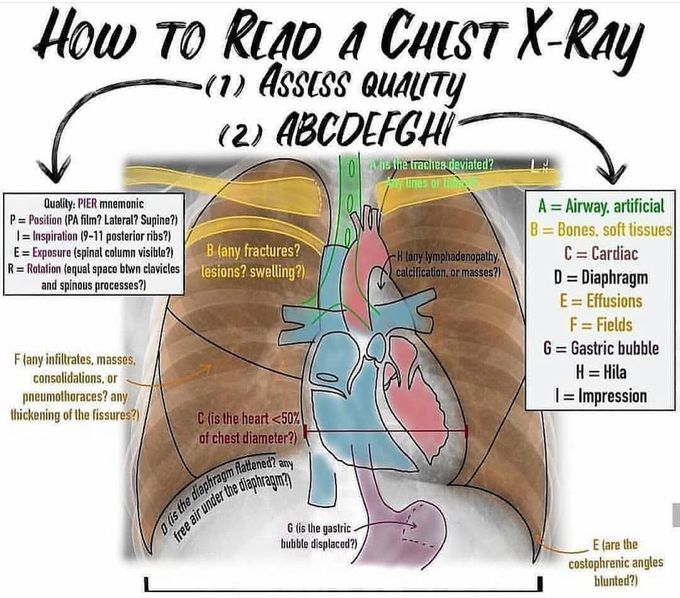 How To Read A Chest XRay MEDizzy
