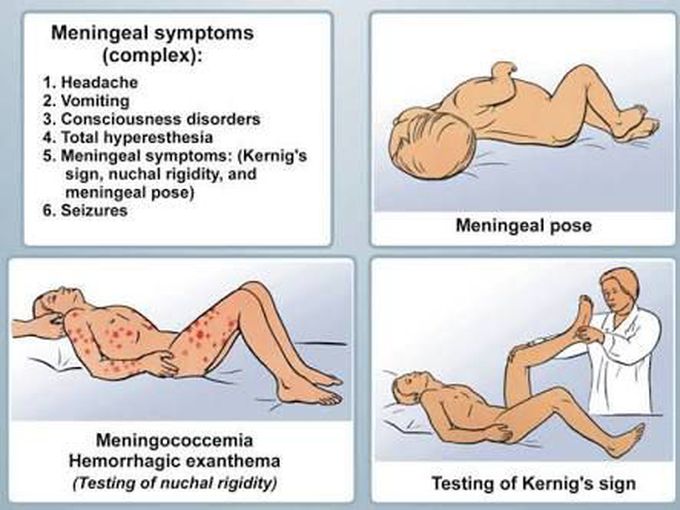 Sign of meningitis :common cause by meningococci