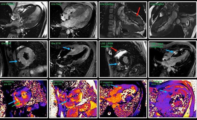 MRI conditional pacemaker / cardiac imaging