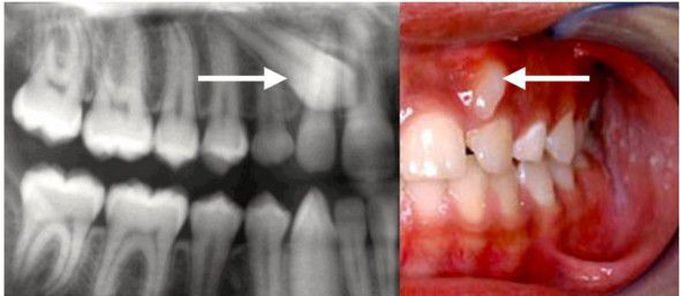 Impacted canine