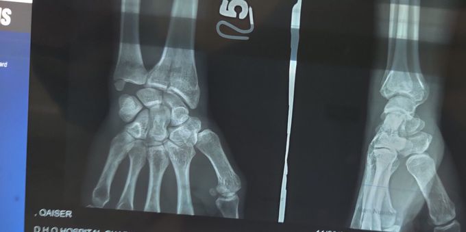 Fracture of Radius