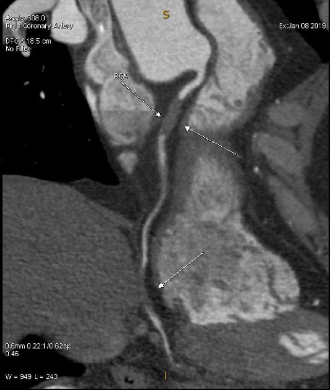 Angiogram of MI patient