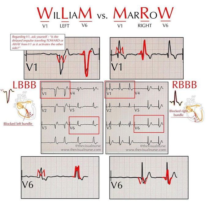 LBBB VS RBBB