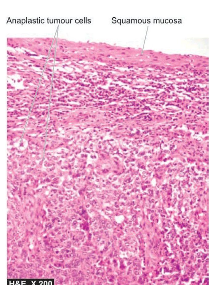 Nasopharyngeal carcinoma, non-keratinising