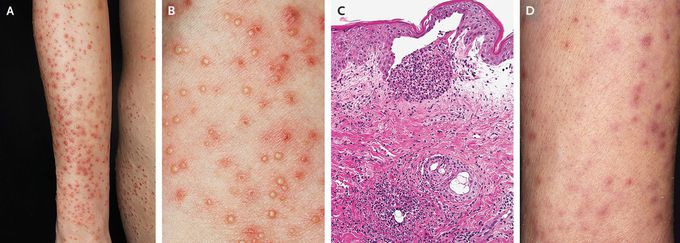 Atopic Eruption of Pregnancy