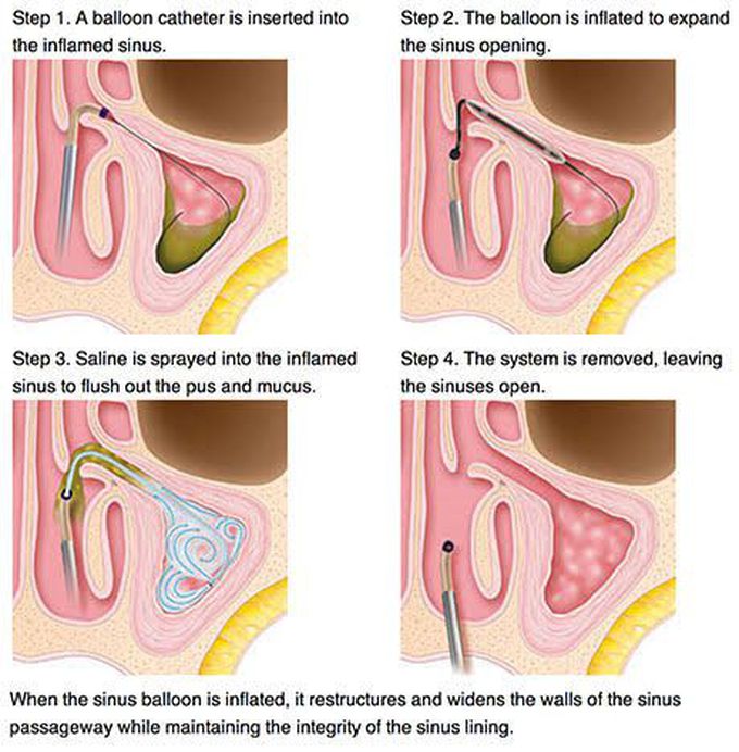 Baloon Sinoplasty