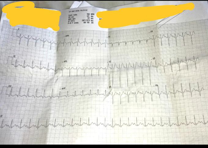 ECG of an 20 year old male, came in to A&E with palpitations and feeling dizzy and S.O.B and has stated CHEST PAIN