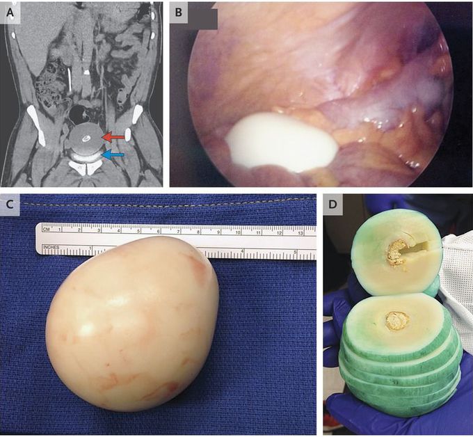 Peritoneal Loose Body