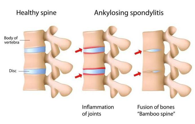 Spondylitis