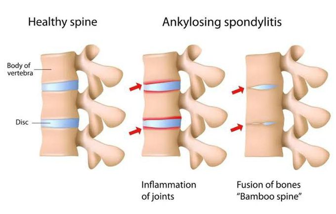 Spondylitis