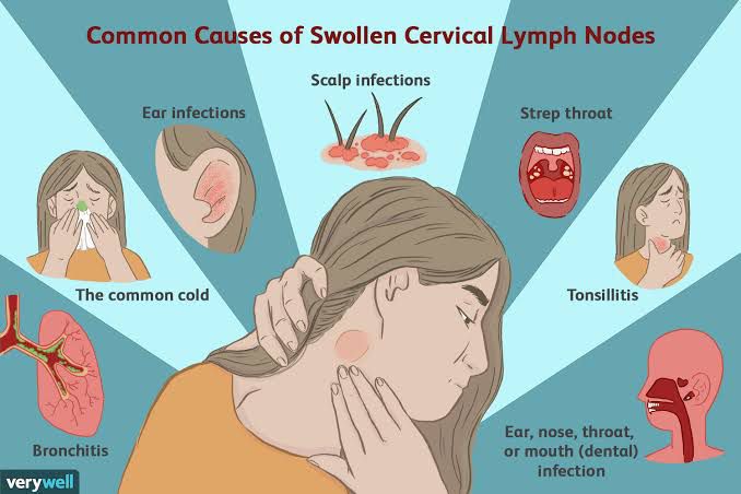 swollen-lymph-nodes-common-causes-medizzy