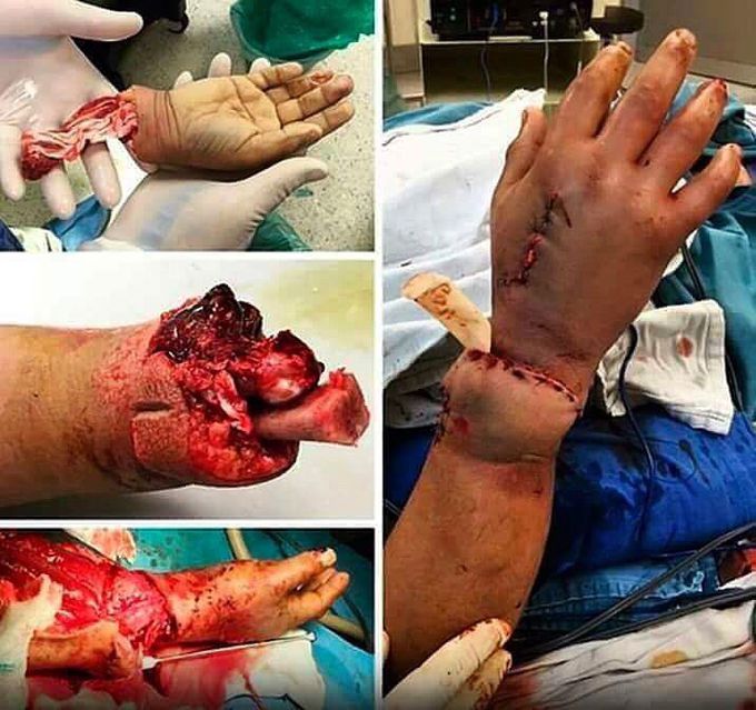 Hand reconstruction surgery!