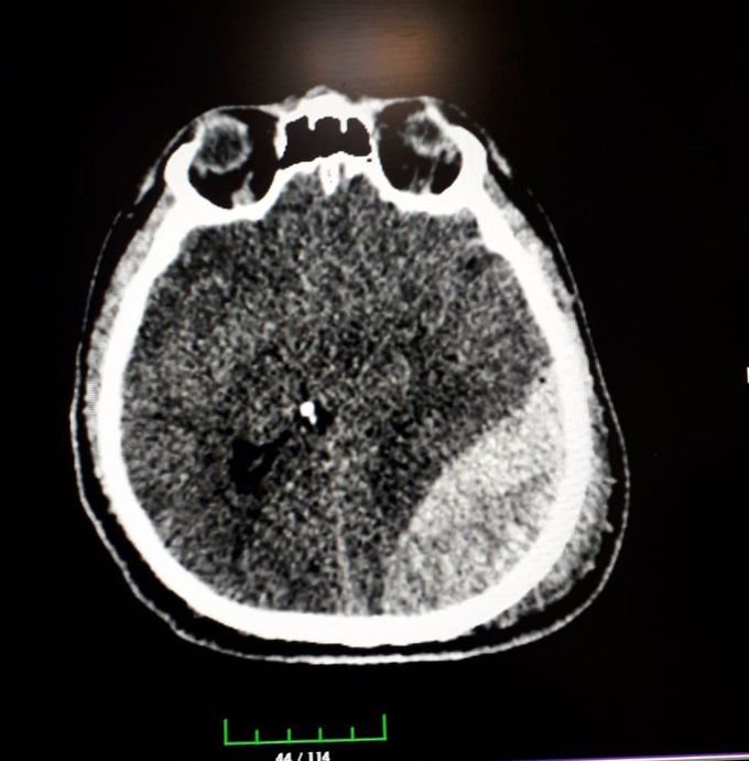 Epidural hematoma