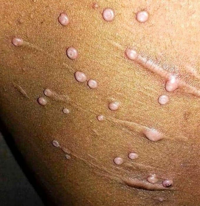 Molluscum contagiosum virus infection