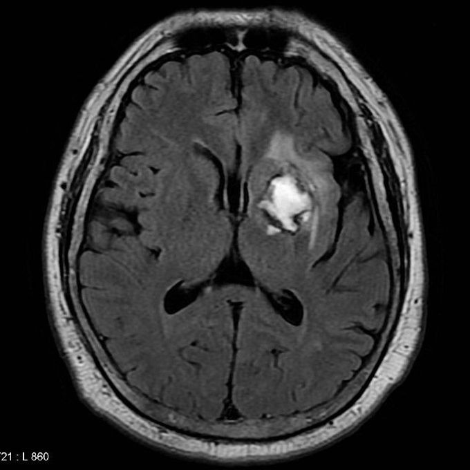 Subacute hemorrhagic stroke MRI