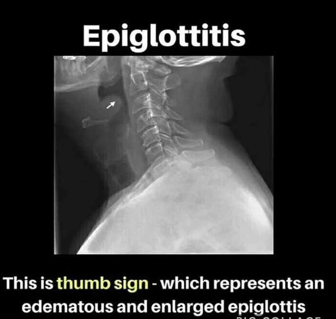 Epiglottitis- Radiology