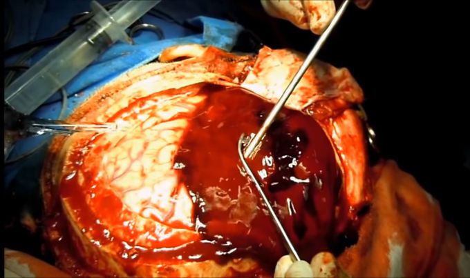 Subdural Hematoma Evacuation