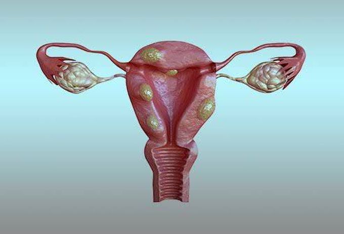 Uterine Fibroids