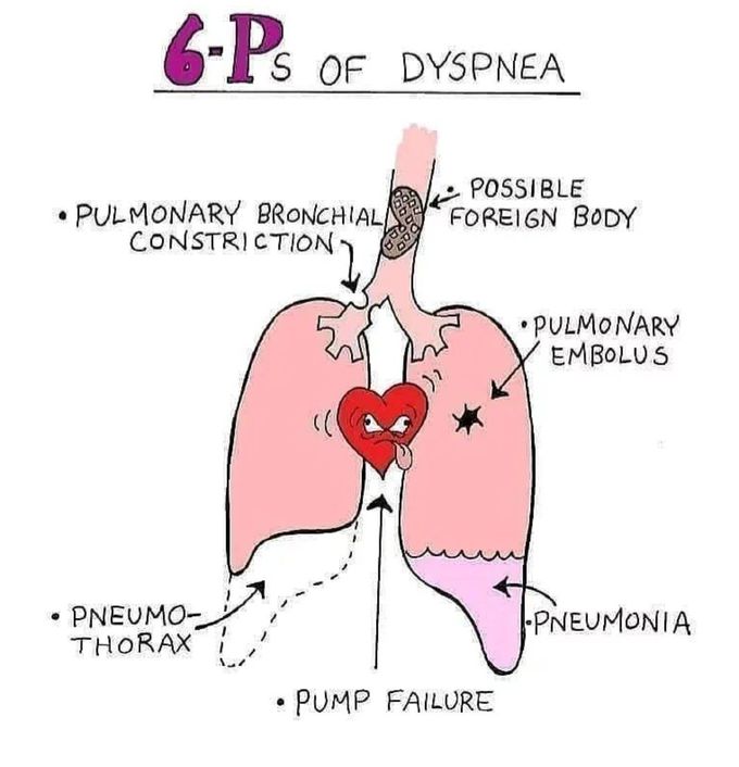 6 P's of Dyspnea