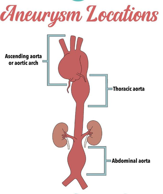 Aneurysms