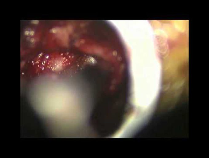Minimally invasive lumbar foraminotomy