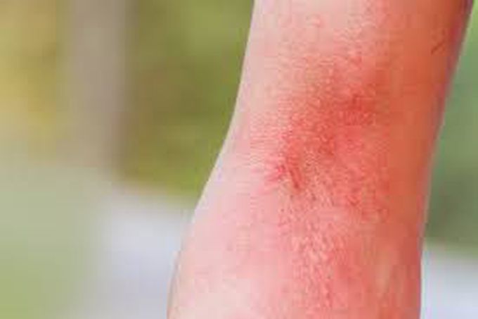 Causes of anhidrosis