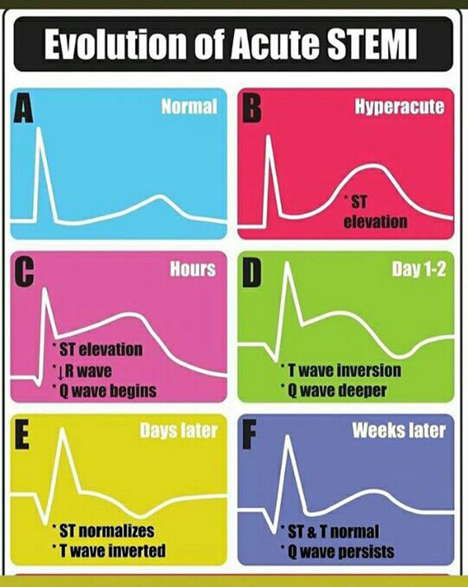 Evolution of acute STEMI