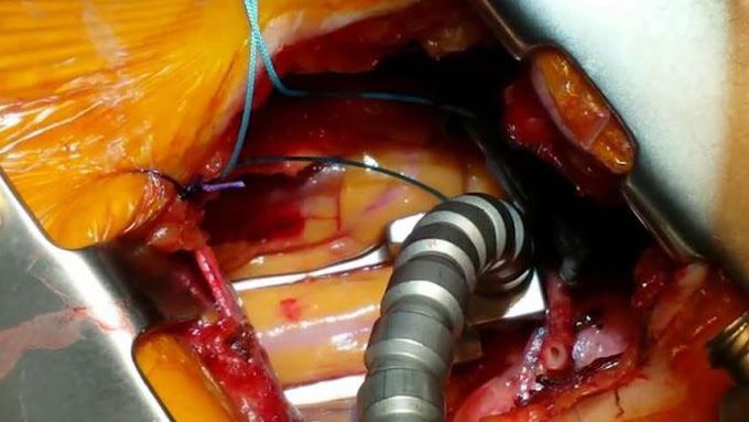 Minimally Invasive Direct Coronary Artery Bypass (MIDCAB)