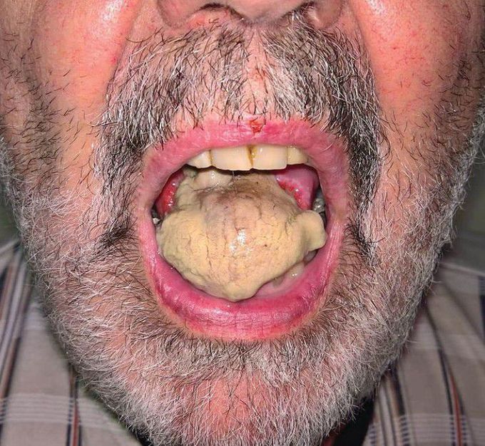 Giant cell arteritis-Tongue necrosis