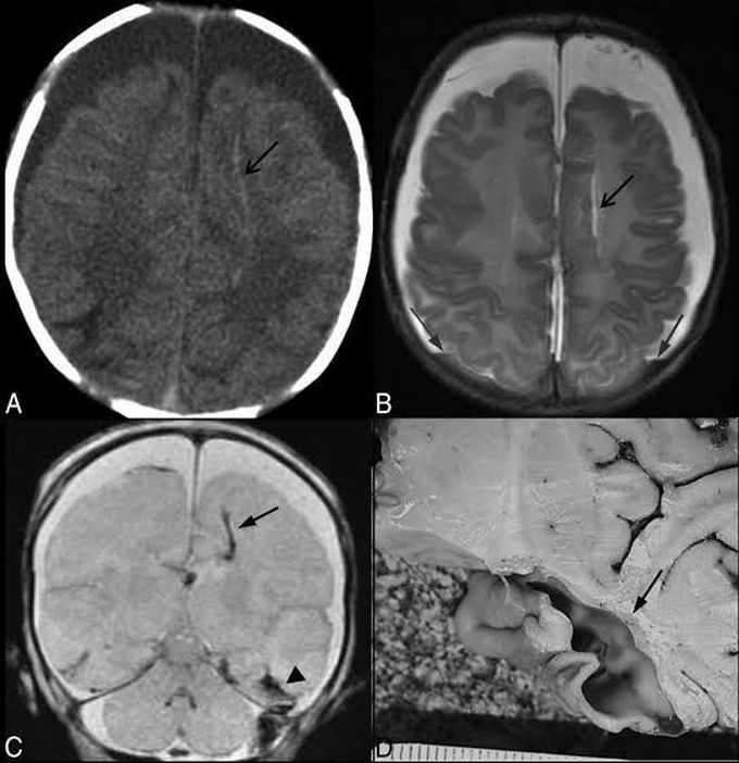 Cerebral laceration