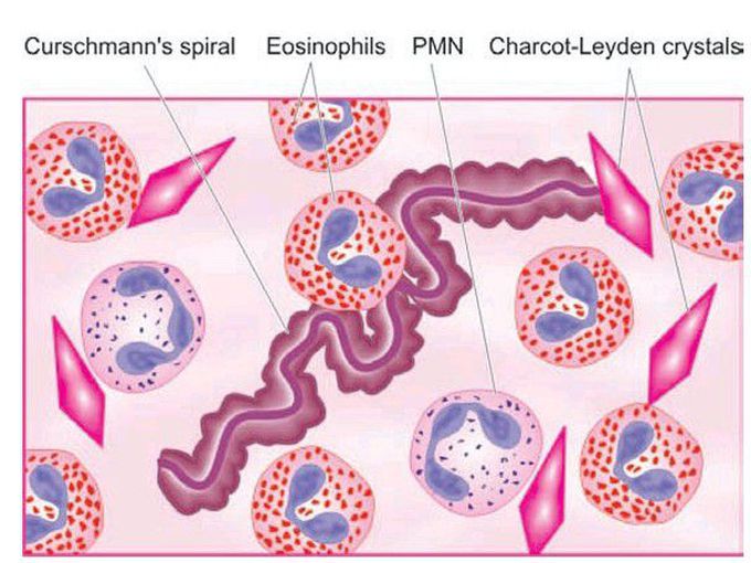 Bronchial asthma