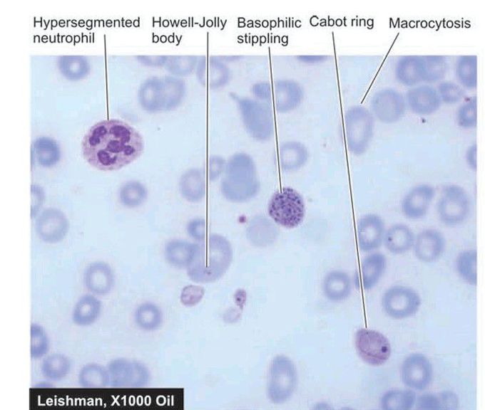 Megaloblastic anaemia.