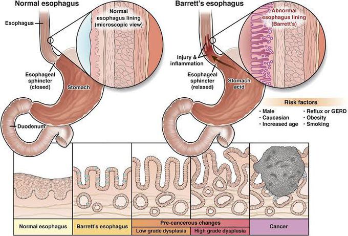 Barret's Esophagus