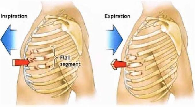 How flail chest occurs?
