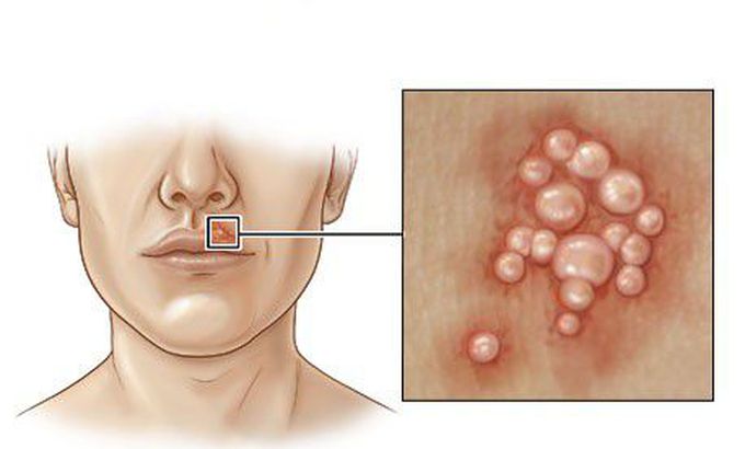 Cause of Herpes simplex virus