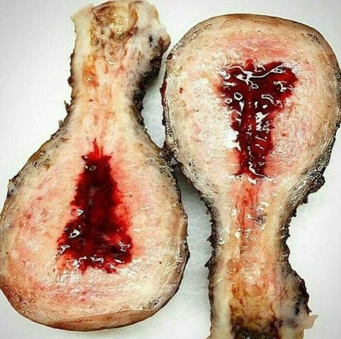 Uterus