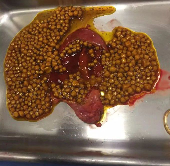 Gallbladder with Multiple Gallstones!